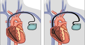 كيف يتم زرع جهاز تنظيم ضربات القلب