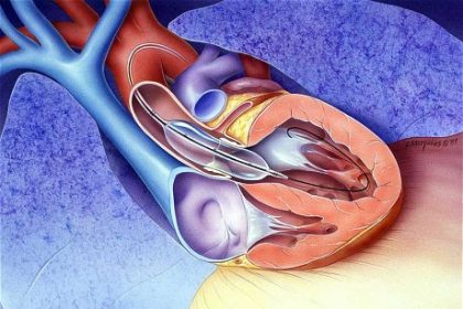 توسيع الصمام الميترالي بالبالون