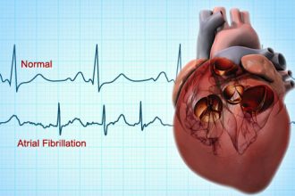 الرجفان الأذيني