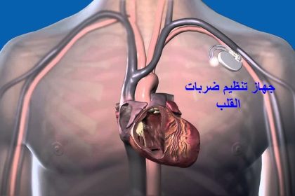 جهاز تنظيم ضربات القلب
