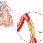 قصور الشريان التاجي