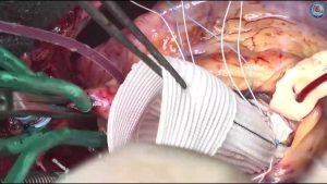 جراحة اصلاح تمدد الشريان الأورطي الصدري