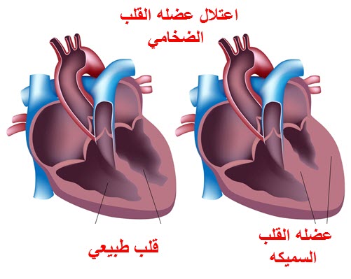 اعراض عضلة القلب
