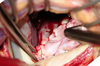 جراحه اصلاح الصمام الميترالي