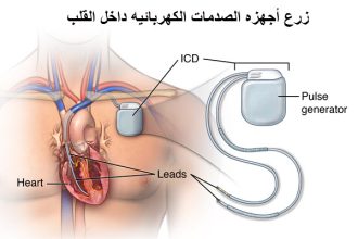 جهاز مزيل الرجفان الداخلي المزروع