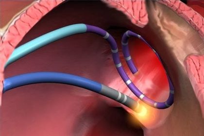 كي البؤرة الكهربائية للقلب بالتردد الحراري