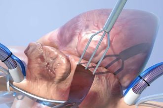 جراحة إصلاح الذبذبه الاذينيه