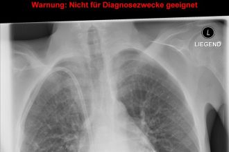 تكلس غشاء التامور نتيجة للالتهاب