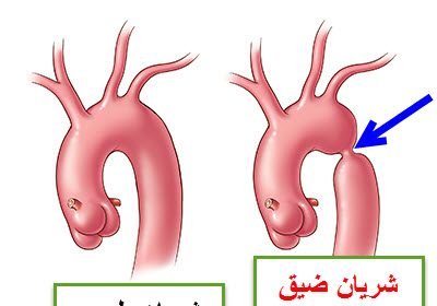 ضيق الشريان الأورطي منذ الولادة