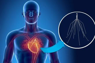 فلتر الوريد الاجوف السفلي المستخدم في حالات الجلطات الرئوية المتكررة