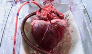قلب معد للزراعه داخل مريض