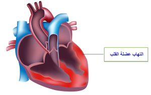 التهاب عضلة القلب