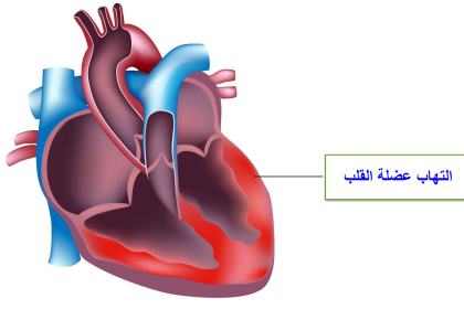 التهاب عضلة القلب
