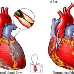 جراحة الشريان التاجي