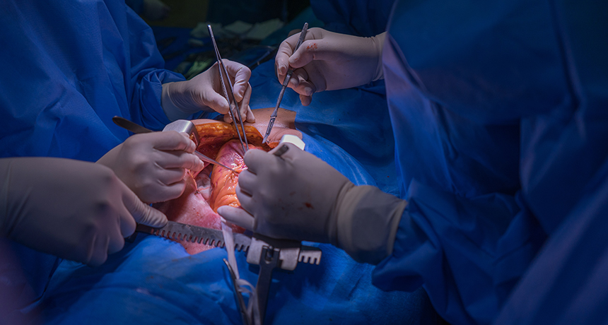 عملية زراعة القلب الجراحية