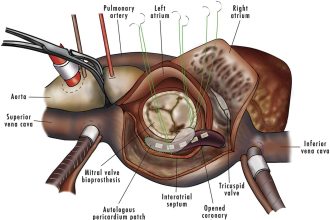 أمراض الصمام الميترالي