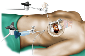 انواع جراحة القلب