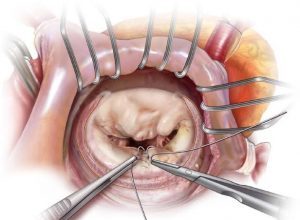 جراحة القلب بالليزر