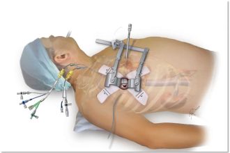 تغيير صمامات القلب