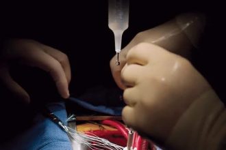 نسبة نجاح عملية تغيير الصمام الأورطي