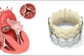 الصمام المعدني