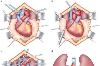 مخاطر عملية القلب المفتوح