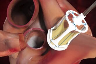 التهاب صمام القلب الصناعي