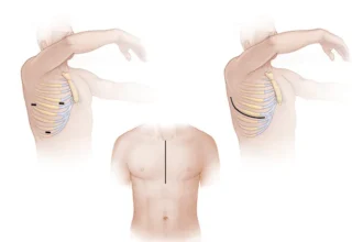 عملية تغيير الصمام الميترالي