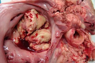 التهاب الصمام الثلاثي الشرفات