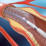 شكل دعامة القلب